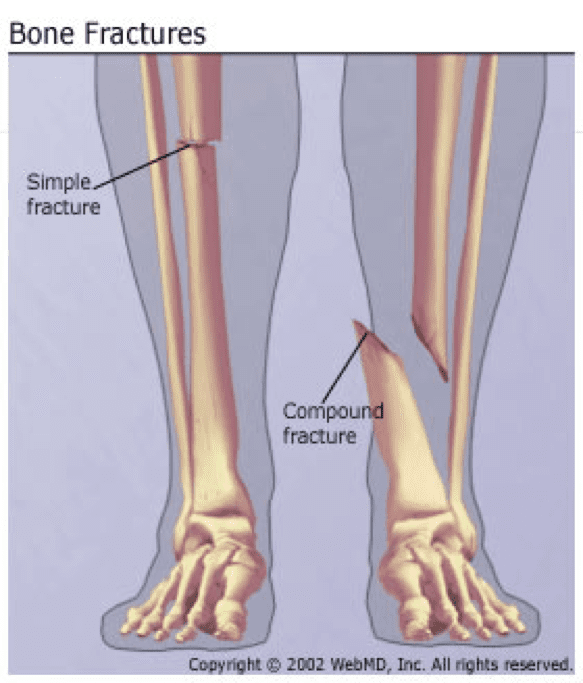 fracture definition