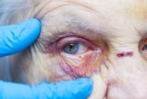 An elderly woman showing signs of physical abuse receiving a medical exam.