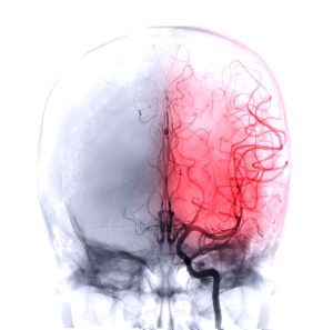 A brain scan where the left hand side of the brain is red and visible lines to represent veins.