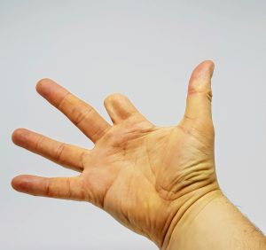 An amputated index finger. Finger compensation for this serious injury could be significant.