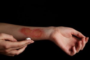 PERSON ATTENDING TO A BAD BURN INJURY ON THEIR FOREARM AFTER A N ACCIDENT IN A RESTAURANT