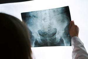 A DOCTOR LOOKING AT AN X-RAY AFTER SLIPS, TRIPS AND FALLS AT A ZOO