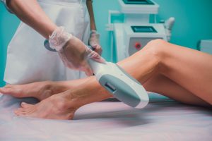 Laser hair removal on the lower legs with hand held laser machine