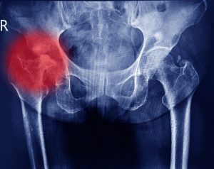 X-RAY OF A HIP JOINT INDICATING PAIN IN RED