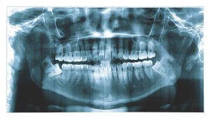 A dental x-ray showing damaged teeth